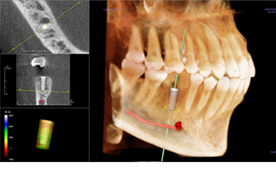 Implantes