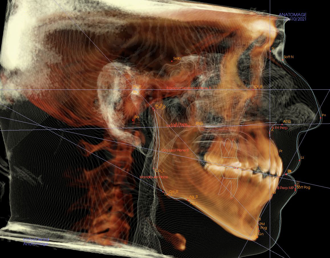 Cefalometría 3D