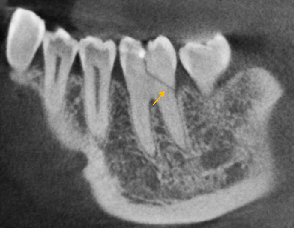 Fracturas coronarias