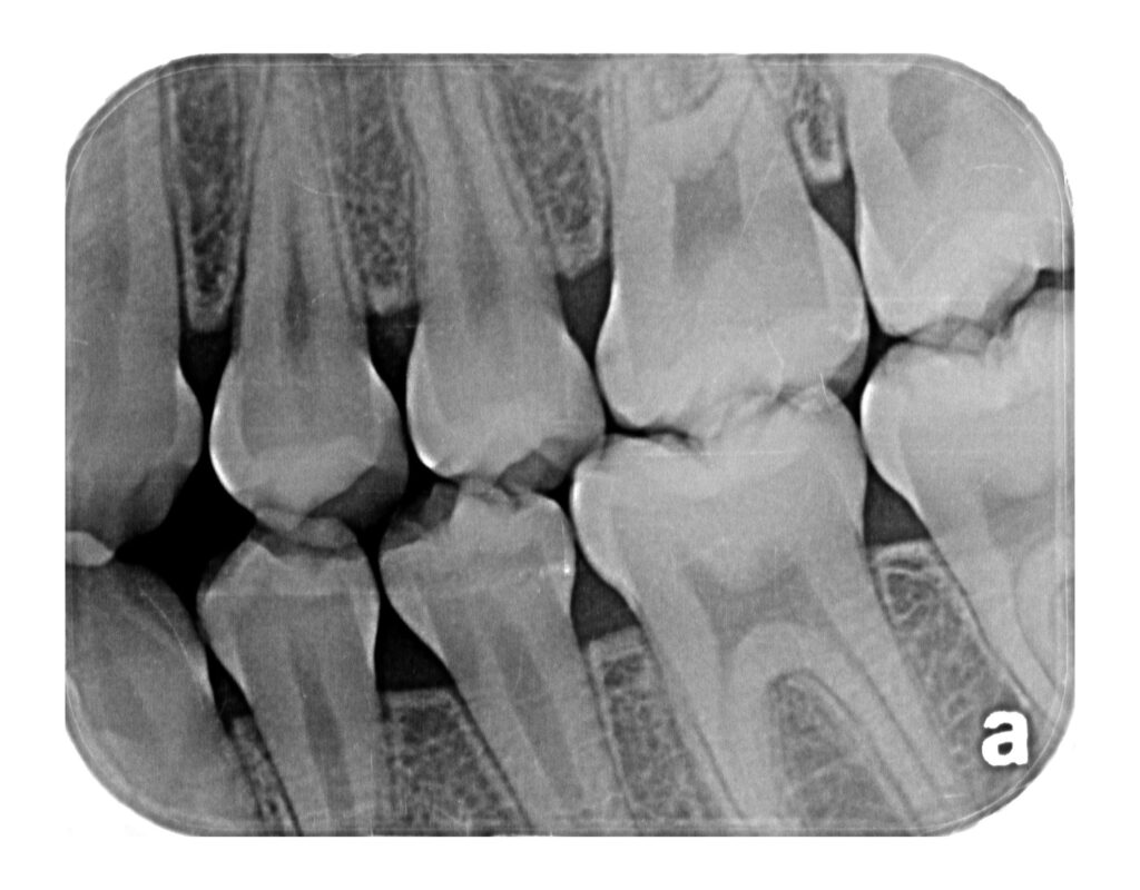 Wing Radiographs Radiografías Intraorales – Imagenes