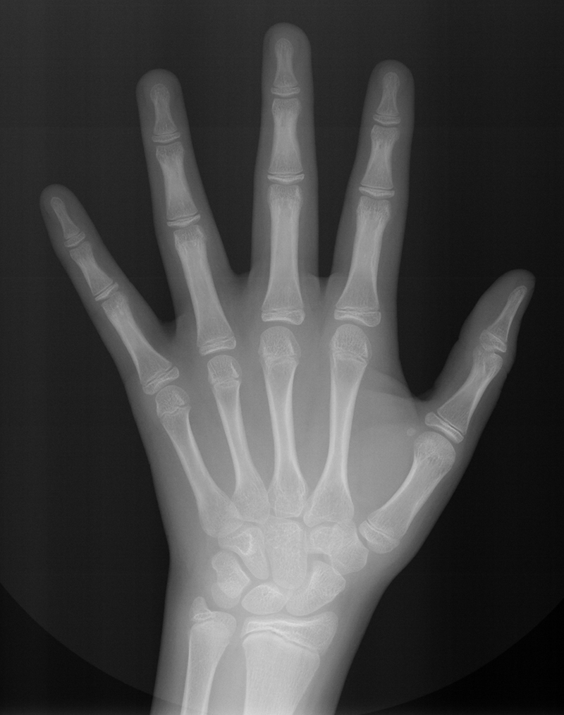 Radiografía carpal