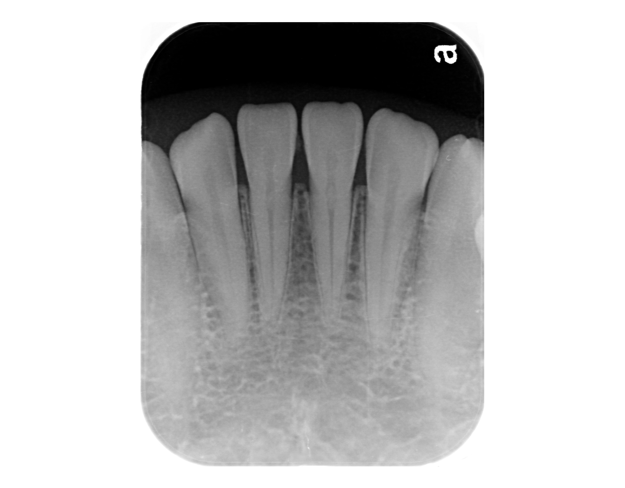 Radiografía periapical