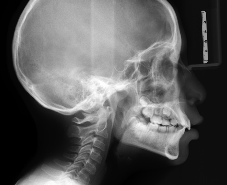 Telerradiografía lateral